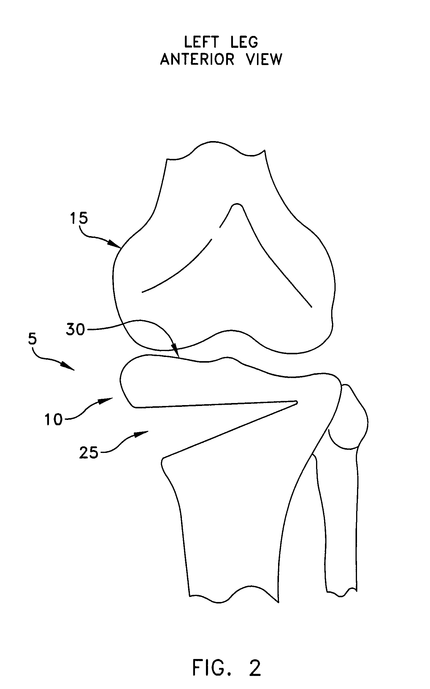 Method and apparatus for performing an open wedge, high tibial osteotomy