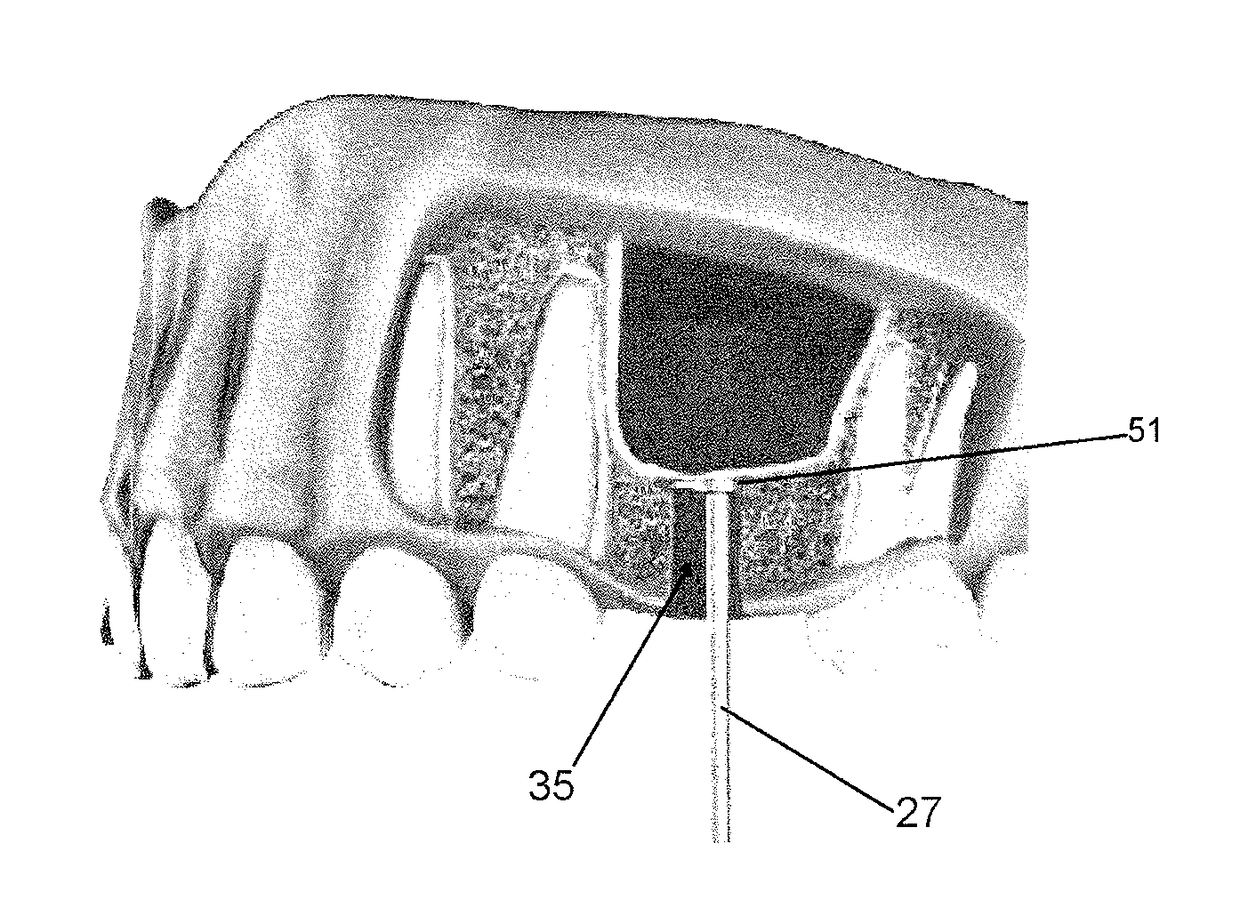 Sinus lift procedure and sidecutting drill