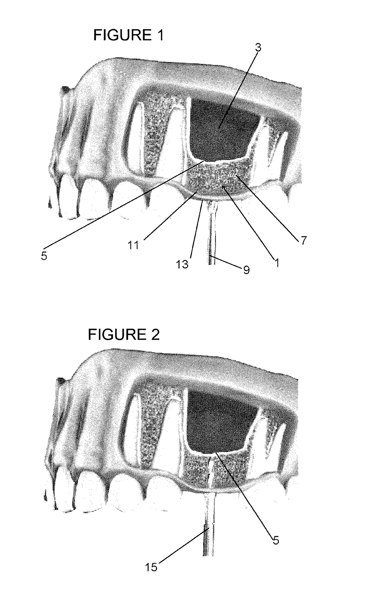 Sinus lift procedure and sidecutting drill