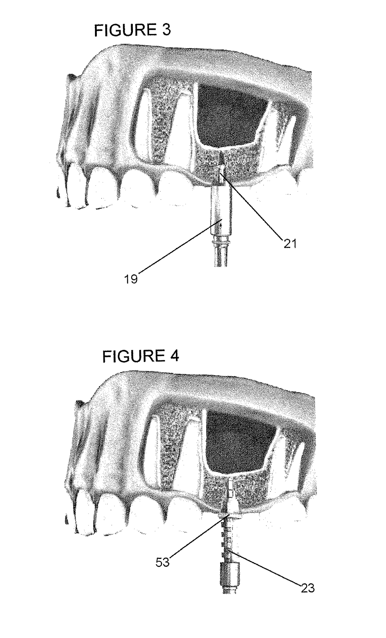 Sinus lift procedure and sidecutting drill