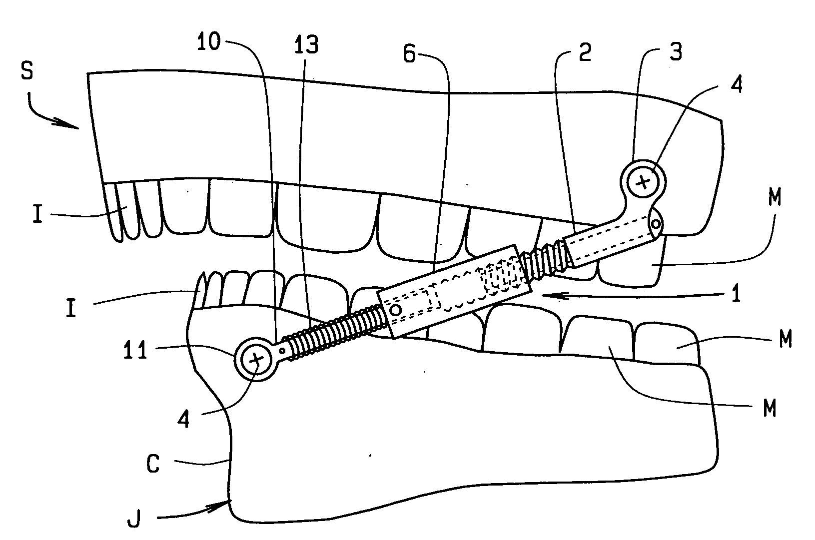 Jaw advancer connected to bone