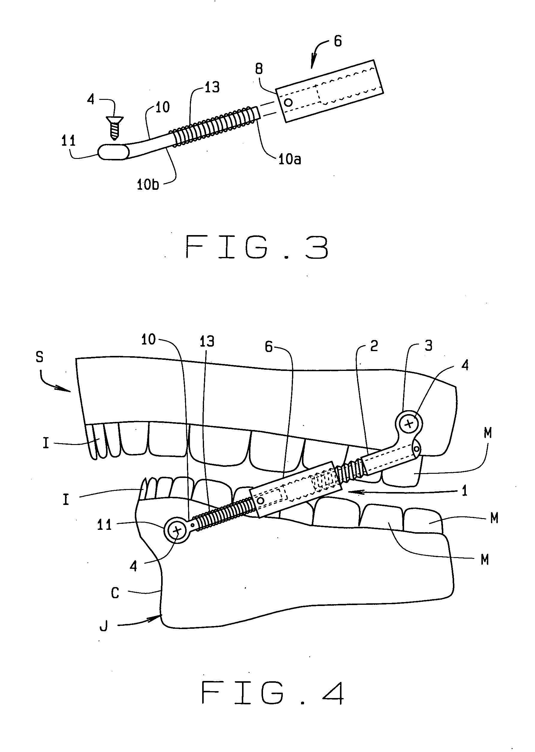 Jaw advancer connected to bone