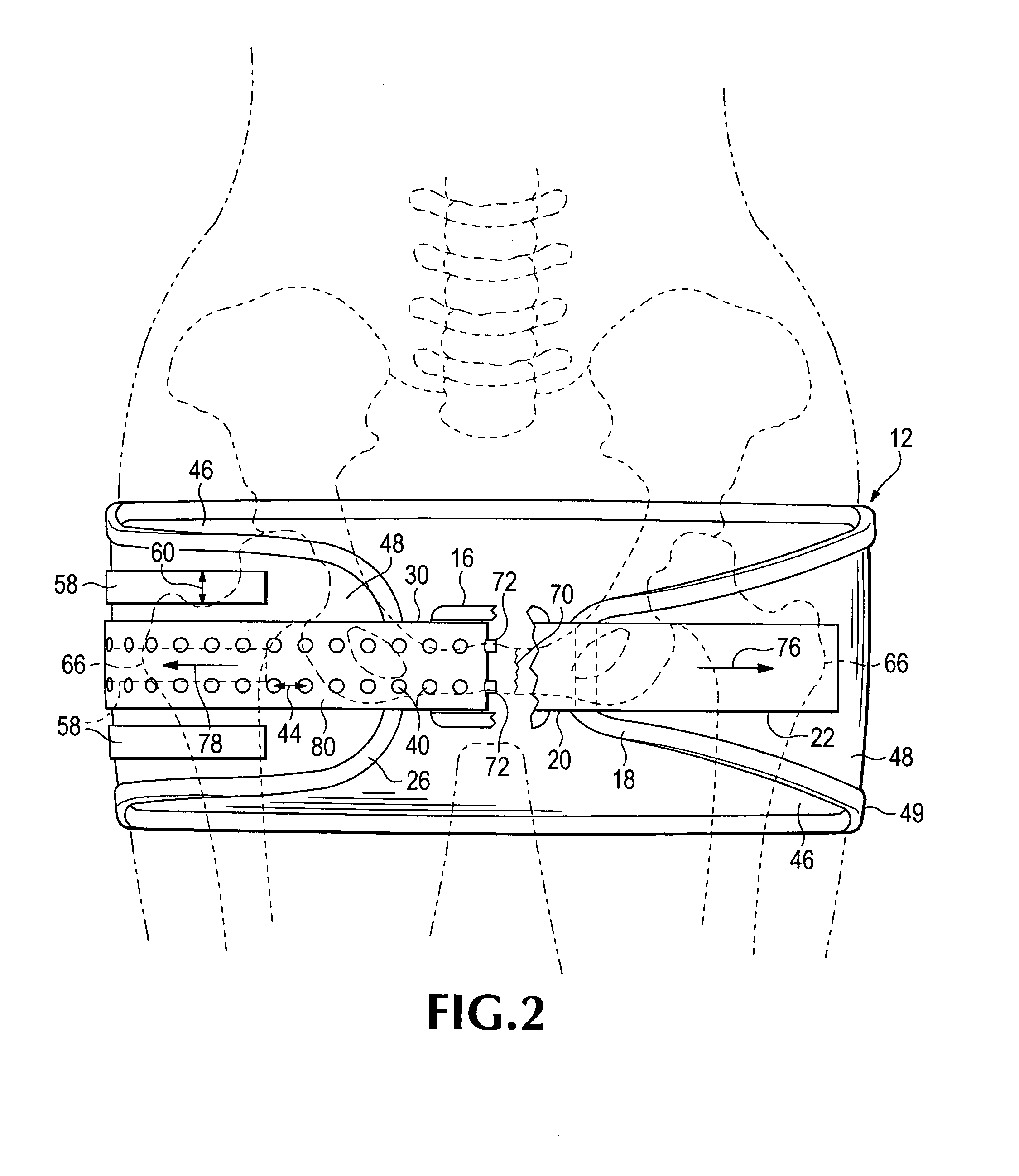 Emergency stabilization of a fractured pelvis