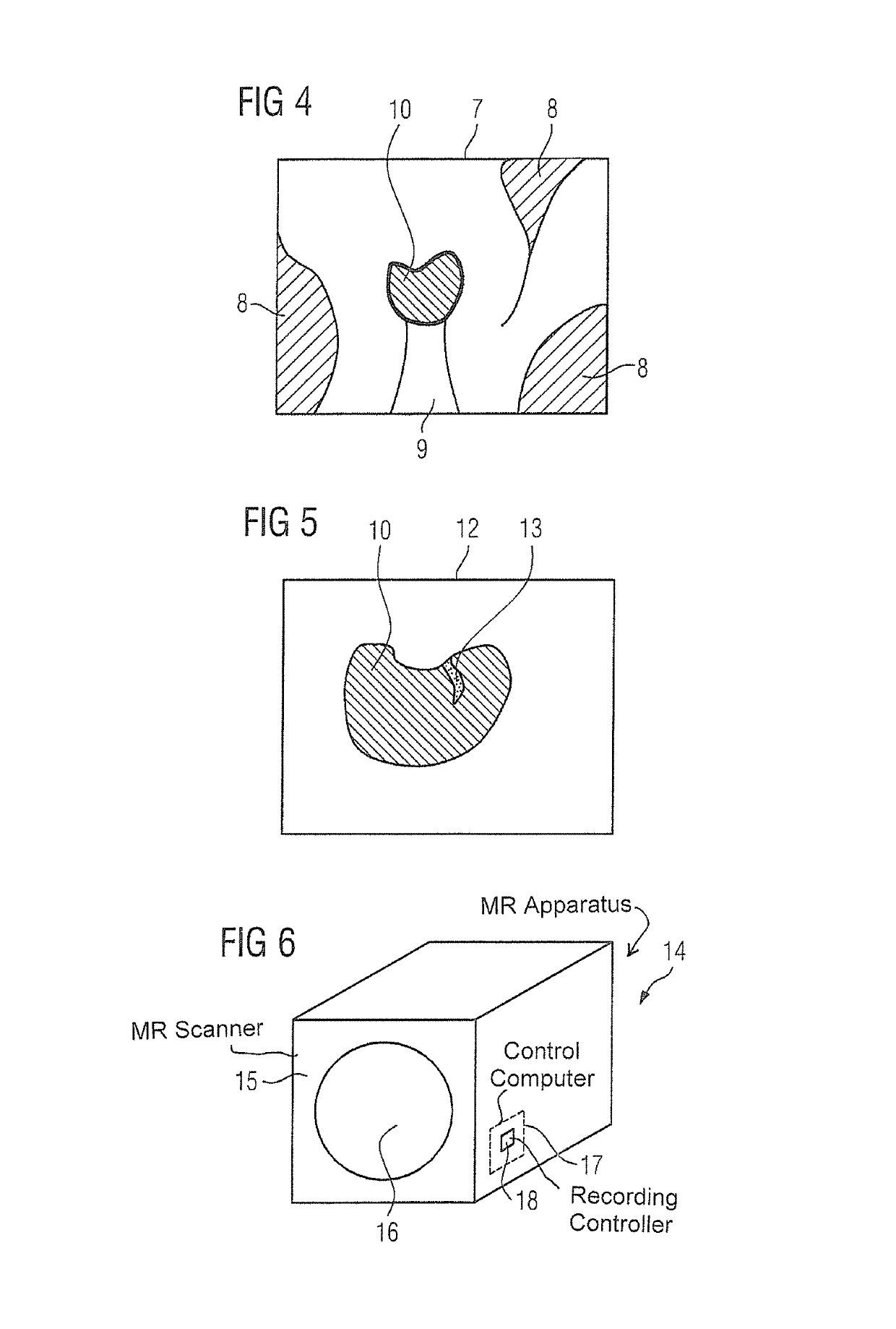 Method and apparatus for recording a magnetic resonance dataset of at least one foreign body in a patient