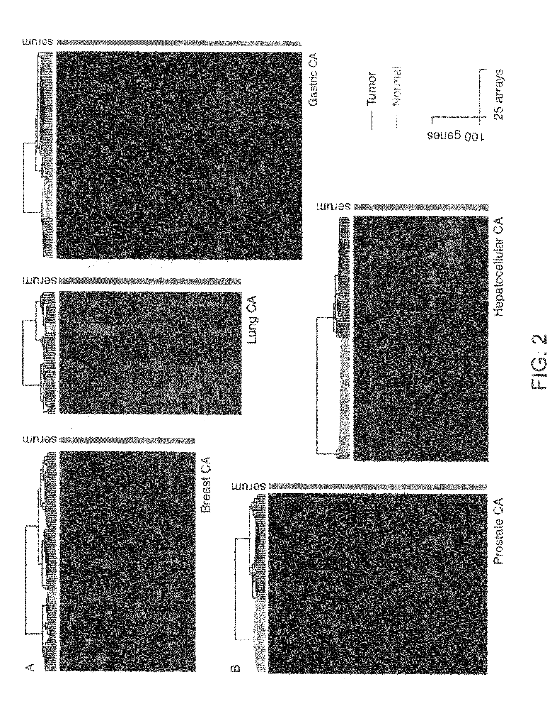 Gene expression signature for prediction of human cancer progression