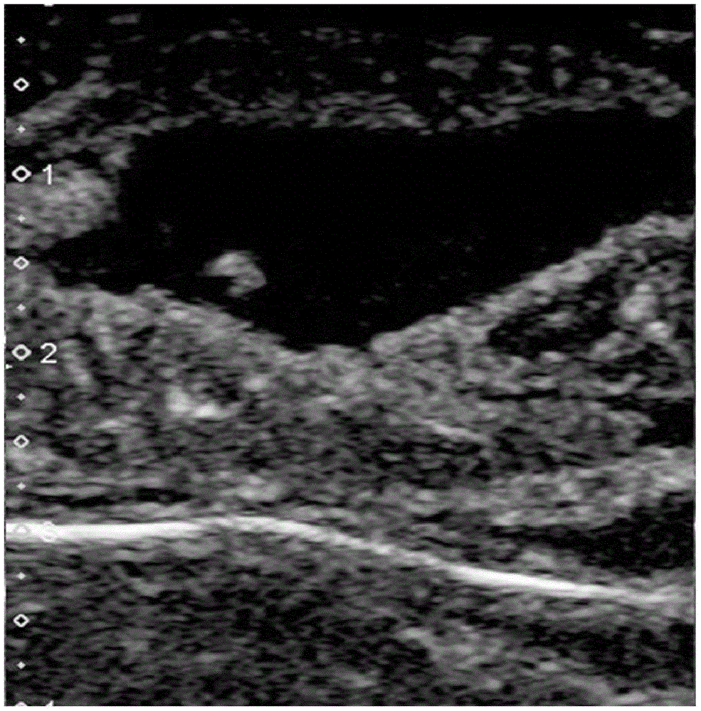 Efficient painless drug for treating local tumor ablation