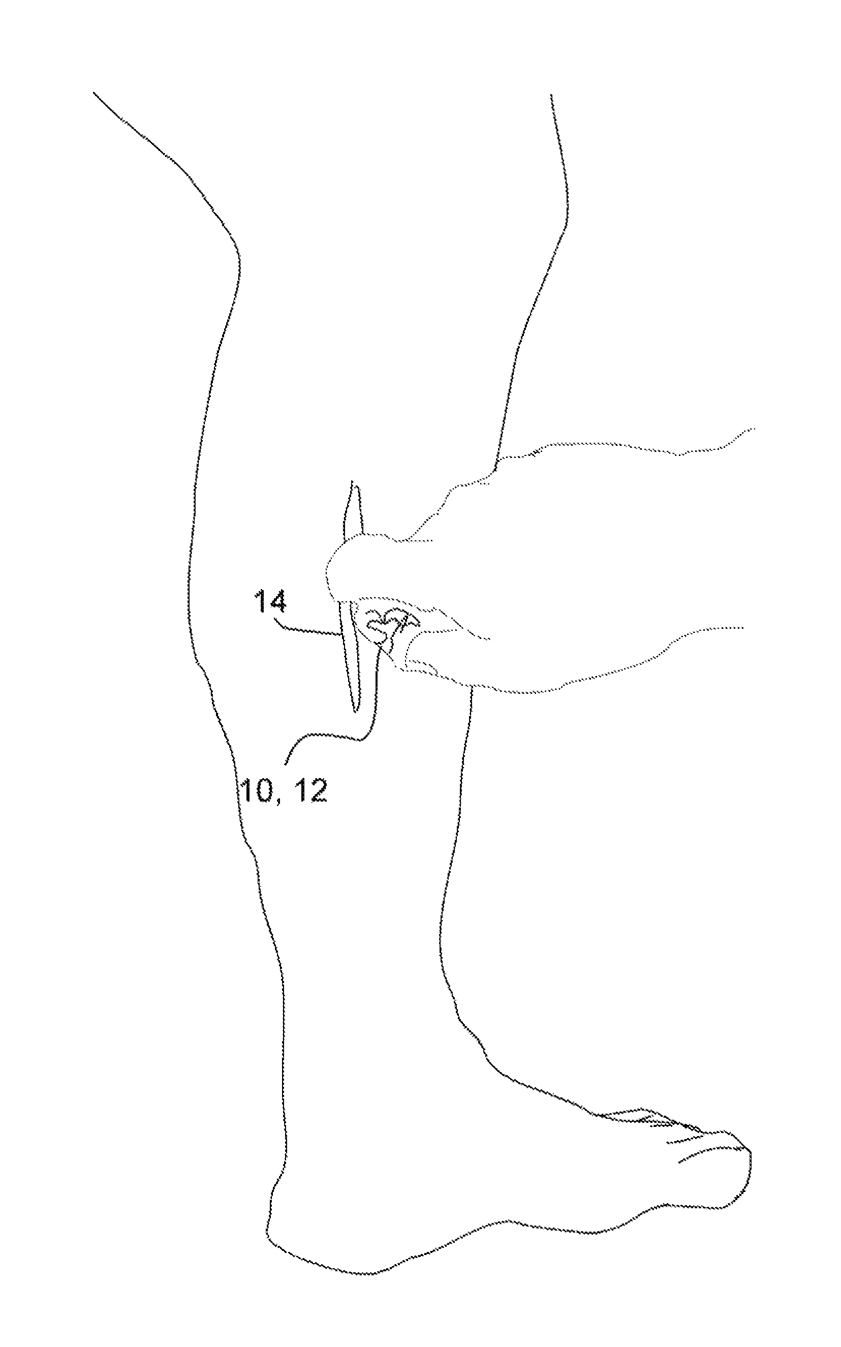 System and method for alleviating the appearance of scars and/or scar tissue