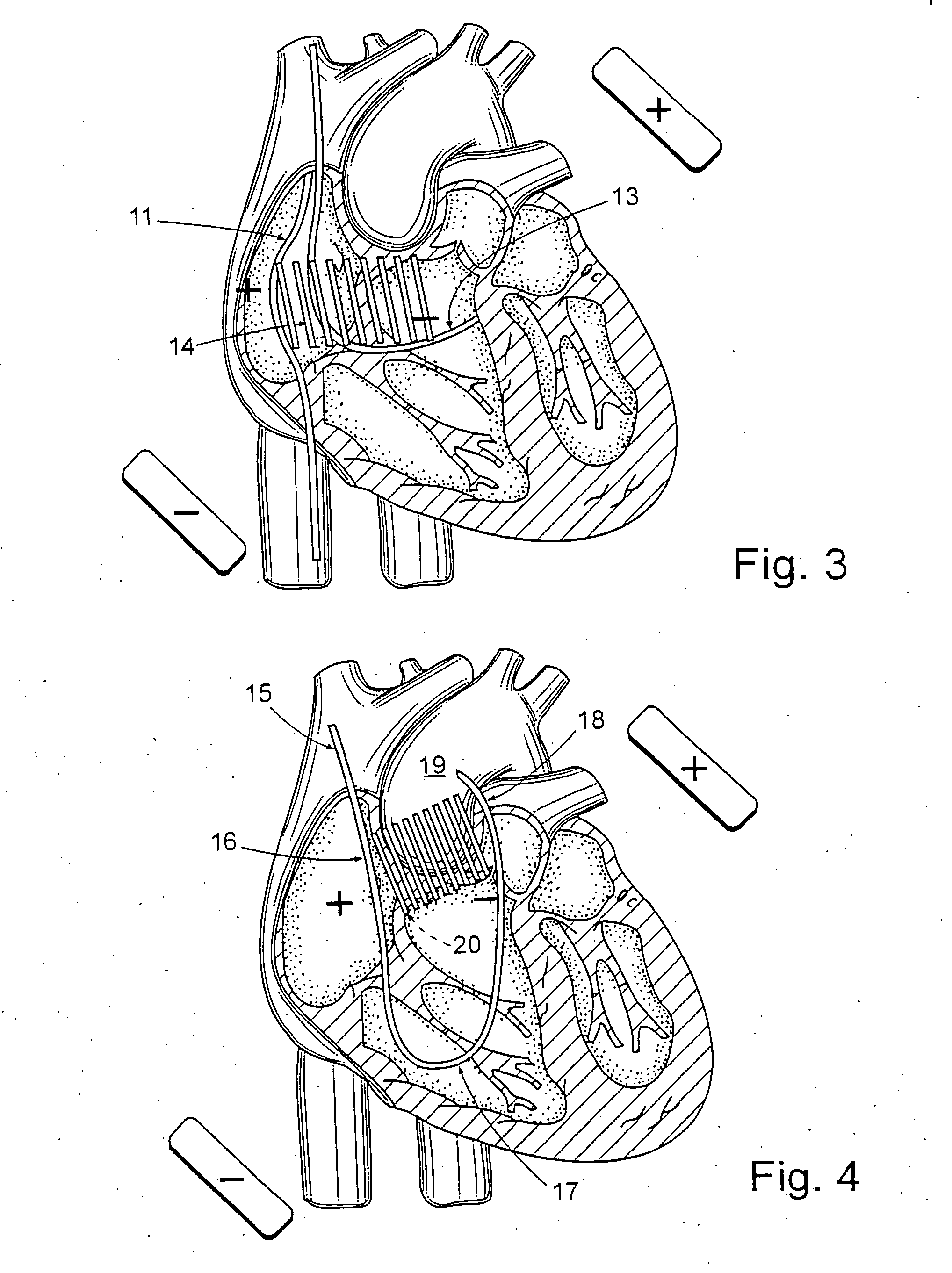 Apparatus and method for cardioversion