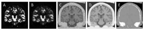 MR structure information constrained non-local mean value guided PET image partial volume correction method