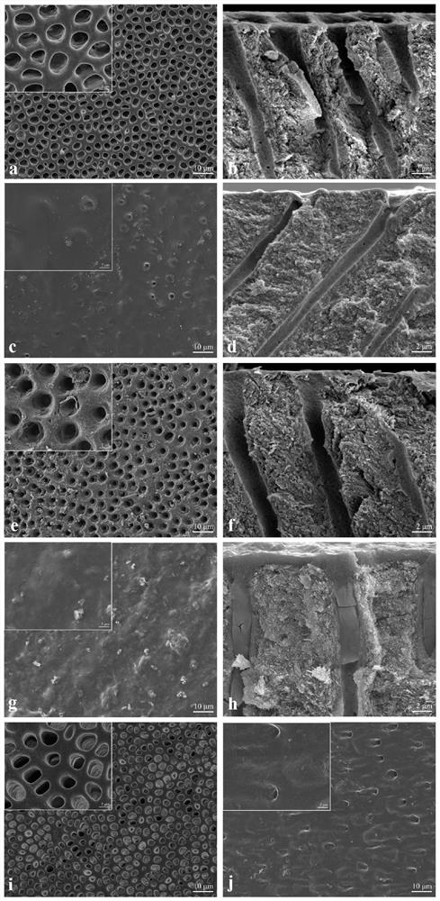 Mineralized material for preventing and treating dentin hypersensitivity and resisting caries as well as preparation method and application of mineralized material