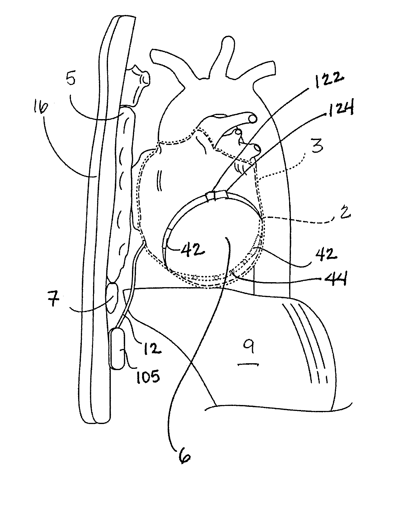 Implanted cardiac device for defibrillation