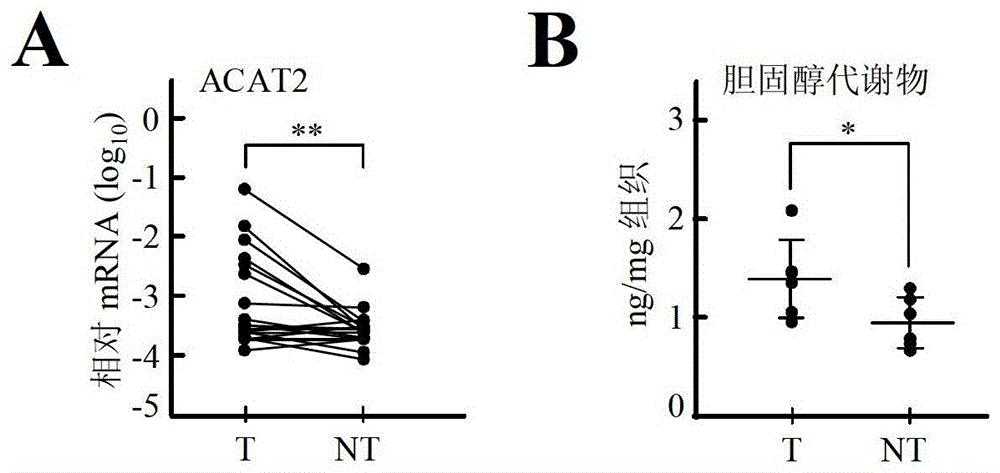 Application of acyl-CoA:cholesterol acyltransferase-2 inhibitors in inhibiting the growth of liver cancer