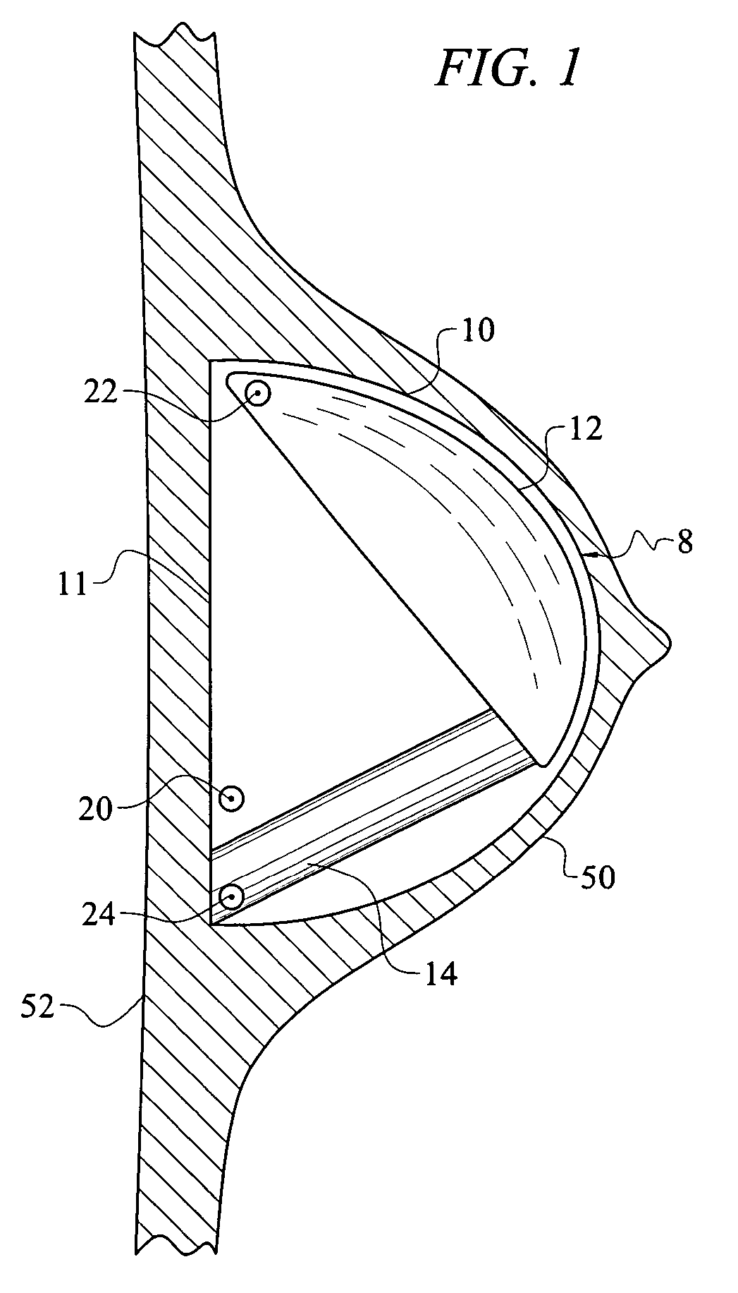 Method and apparatus for reconstructive surgery