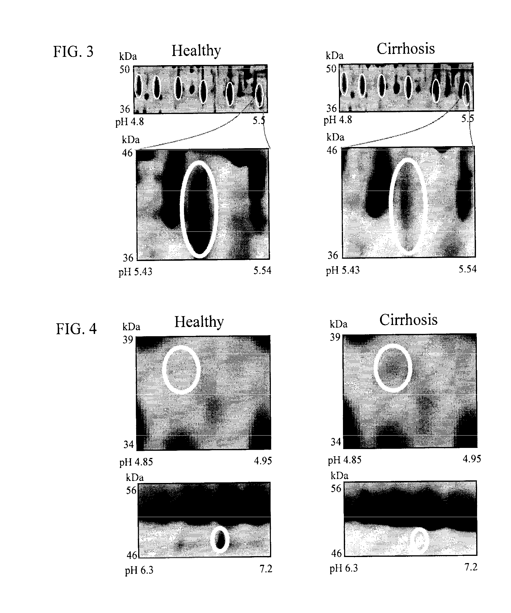 Clinical diagnosis of hepatic fibrosis using a novel panel of low abundant human plasma protein biomarkers