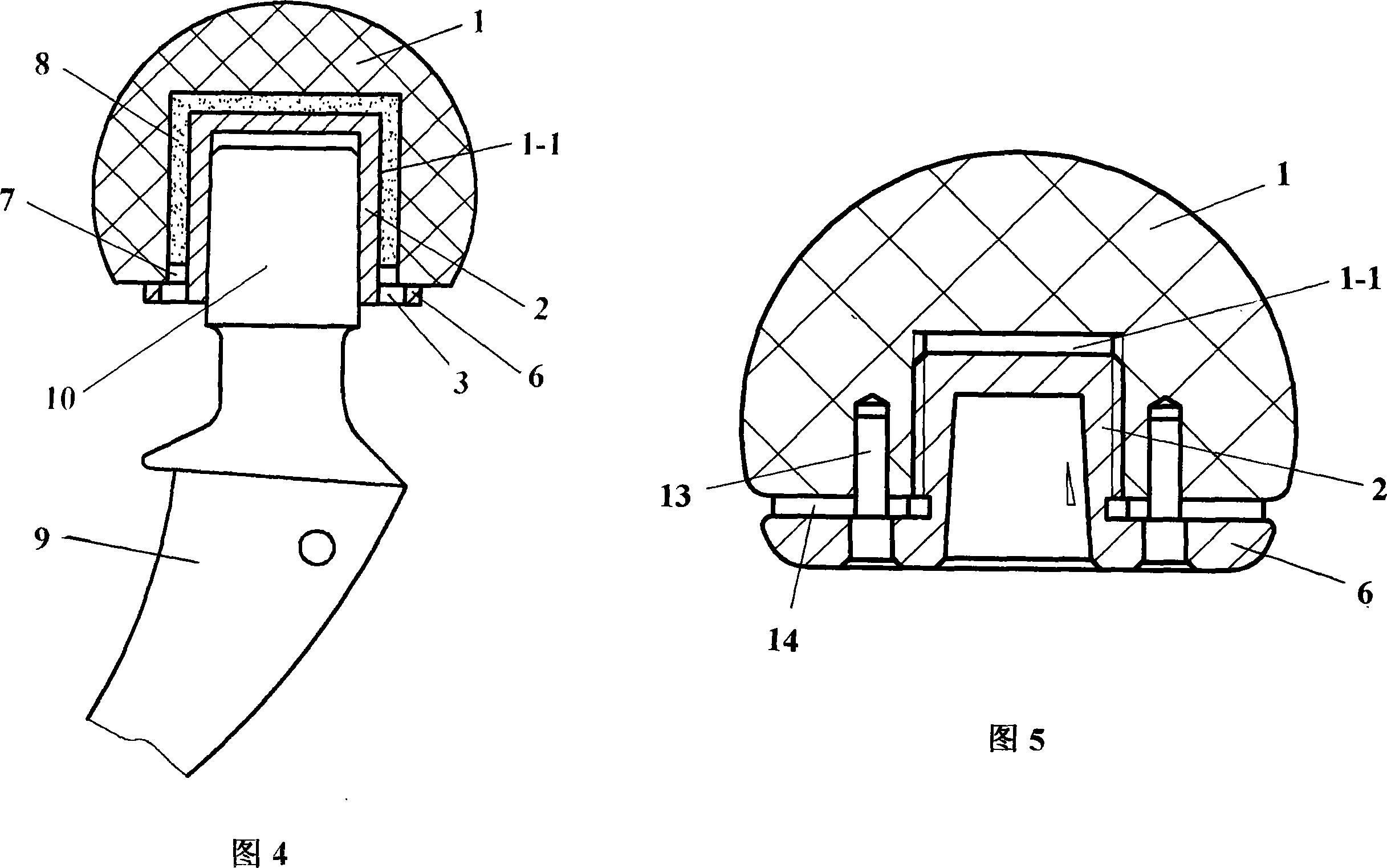 Carbonaceous femoral head prosthesis enchased with metal liner