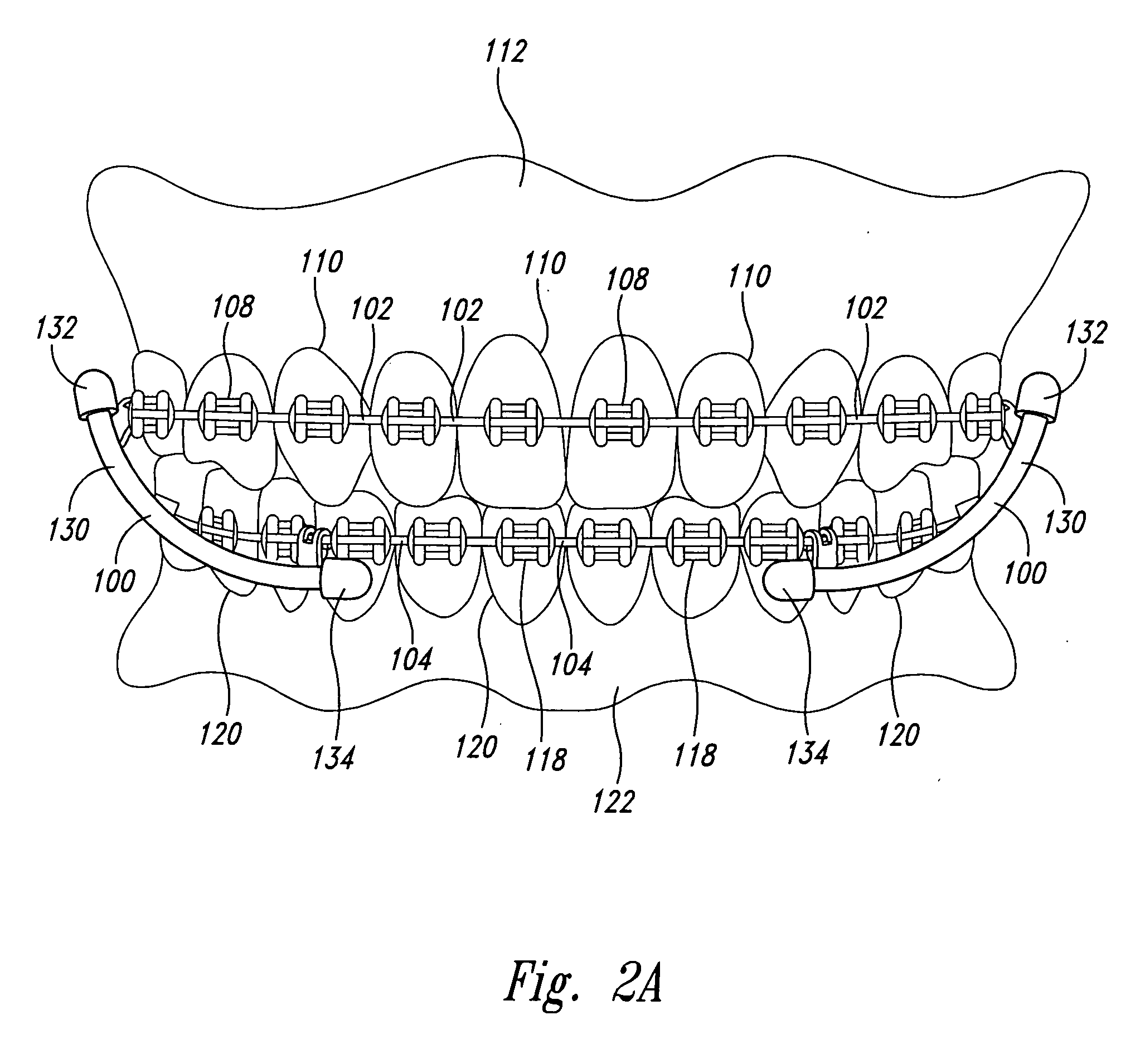 Orthodontic device for attachment to orthodontic wire