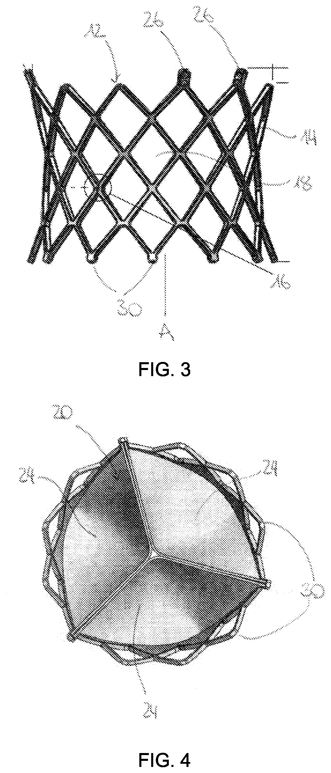 Aortic Stent