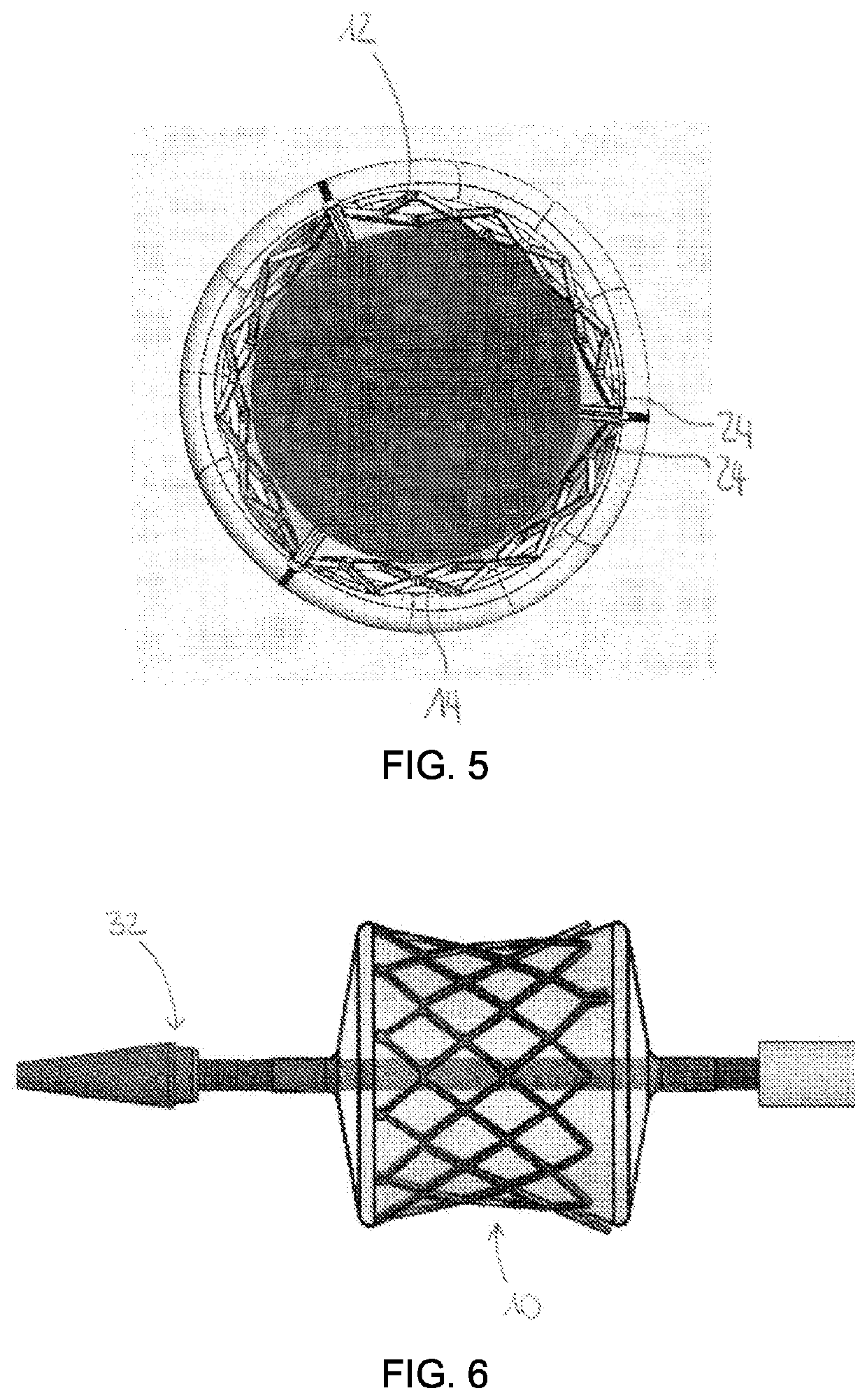 Aortic Stent