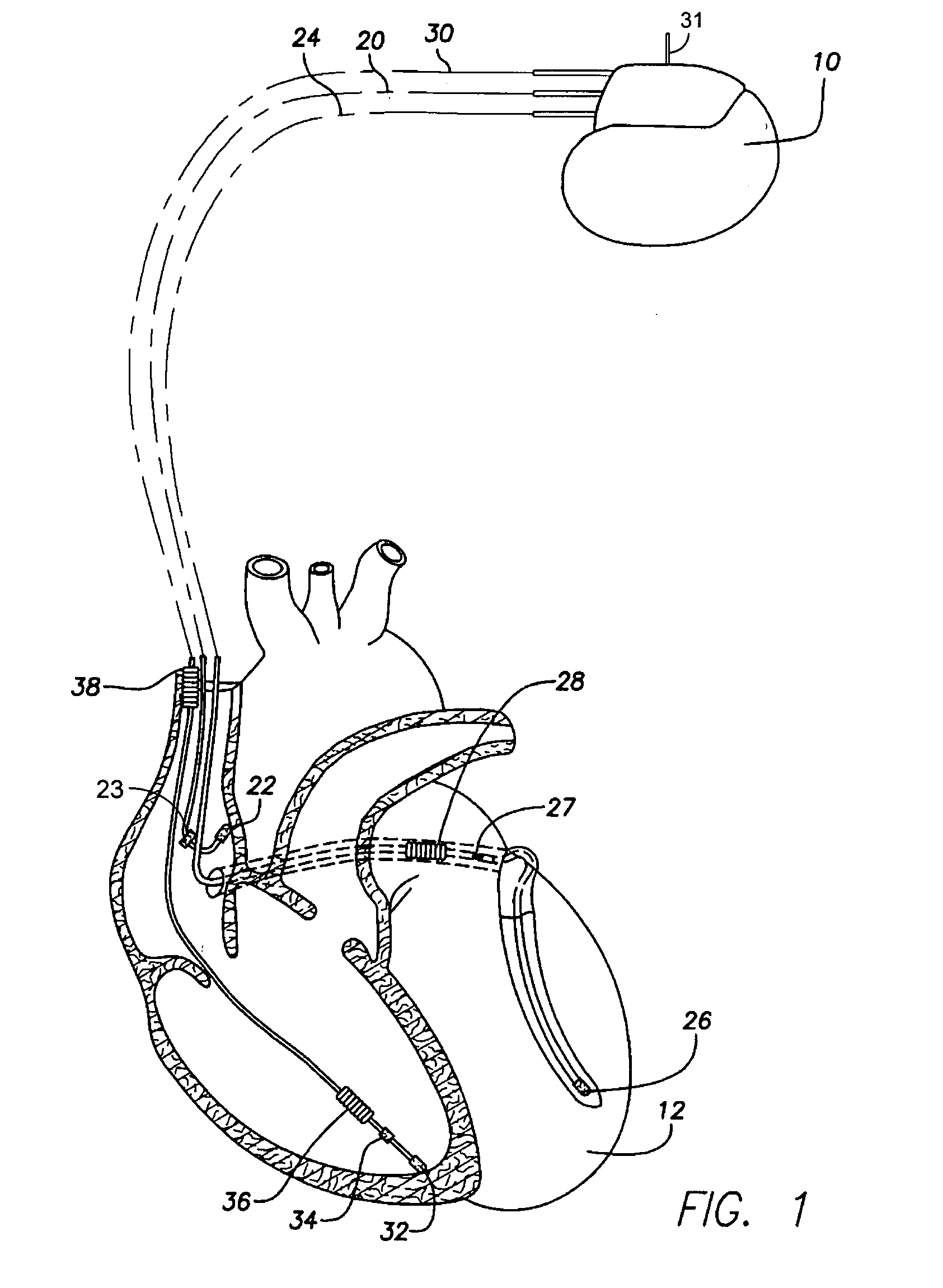 System and method for detecting cardiac ischemia based on T-waves using an implantable medical device