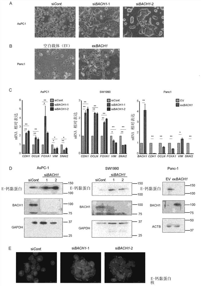 Novel marker of epithelial-mesenchymal transition in pancreatic cancer