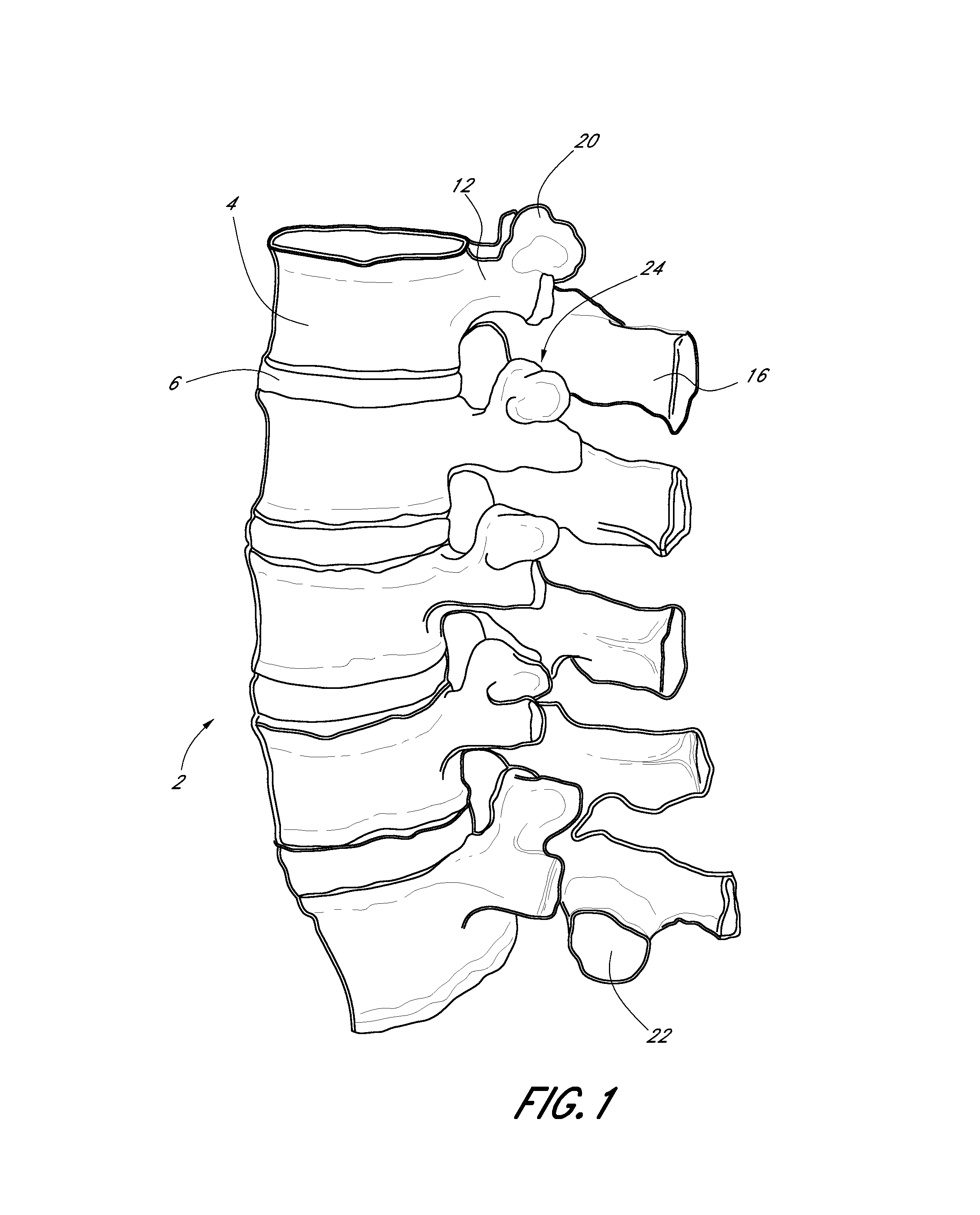 Method of using a vertebral facet joint drill