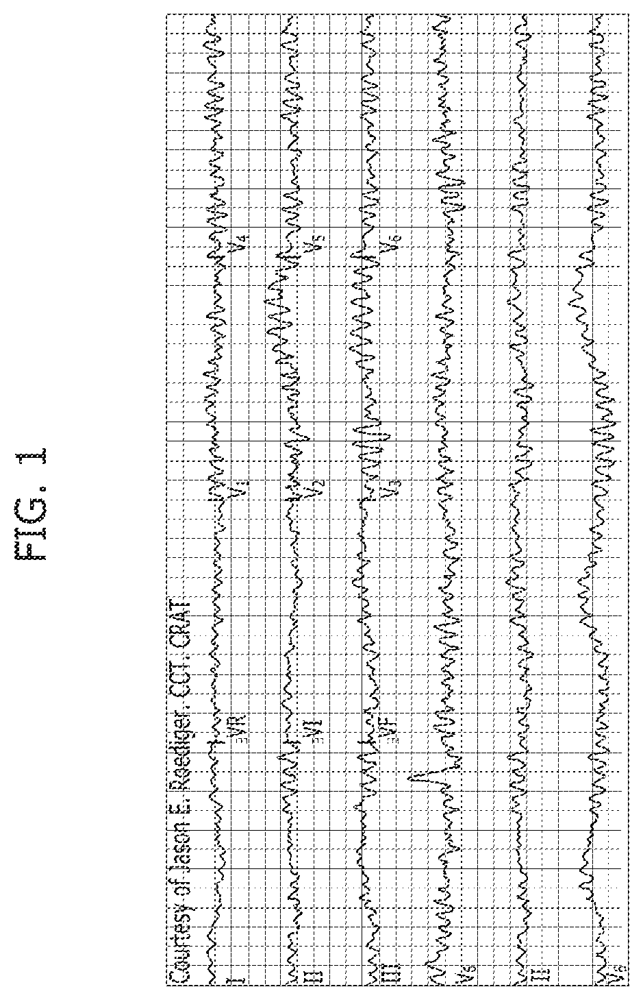 Apparatus and method for detecting qrs of ECG