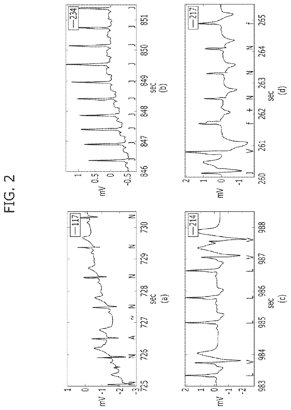 Apparatus and method for detecting qrs of ECG