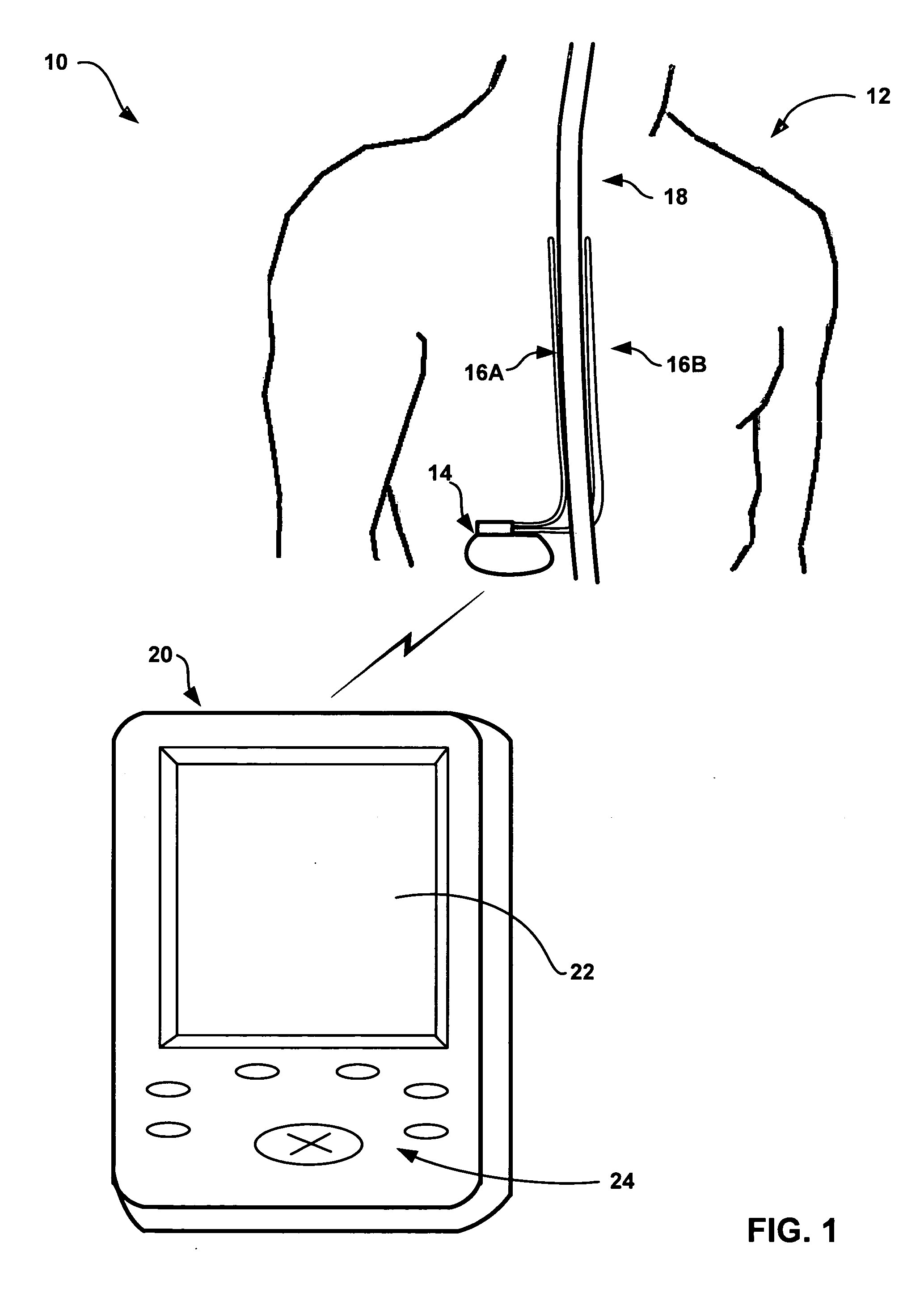 Selection of neurostimulator parameter configurations using genetic algorithms