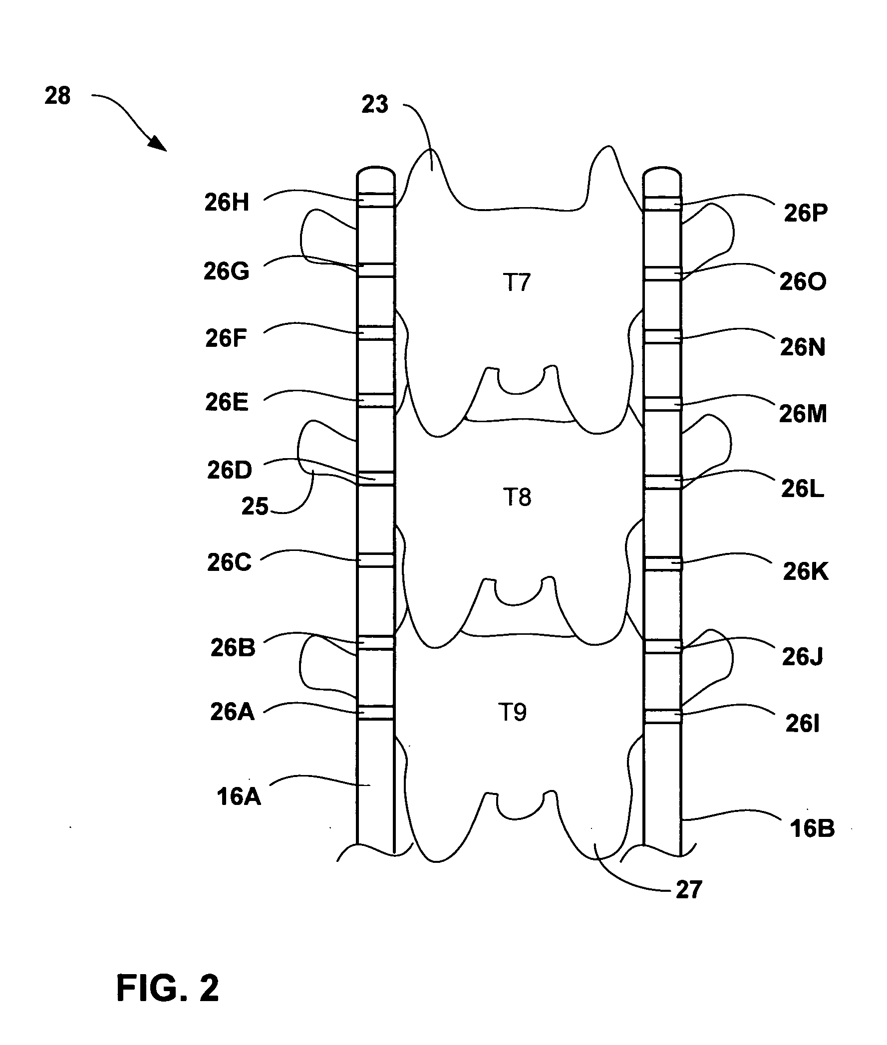 Selection of neurostimulator parameter configurations using genetic algorithms