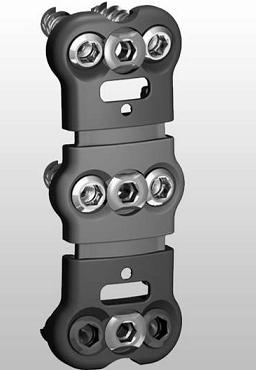 Anterior cervical steel plate fusion fixing system under endoscope