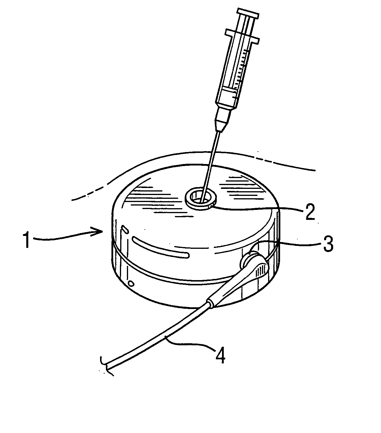 Implantable drug delivery pump