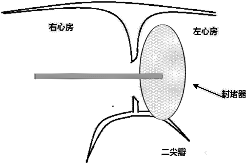 Atrial septal defect plugging device and interventional method thereof