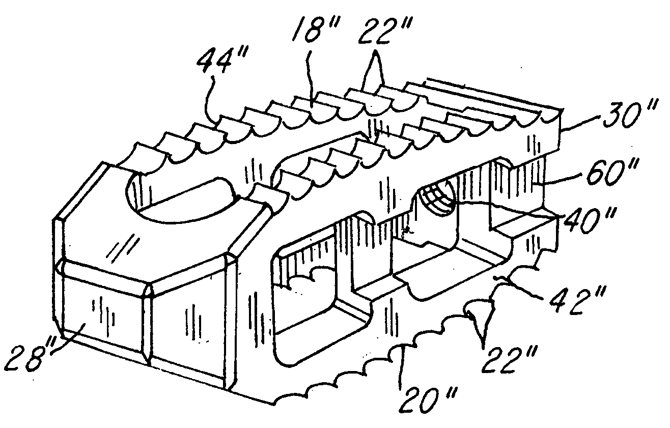 Prosthetic implant with biplanar angulation and compound angles