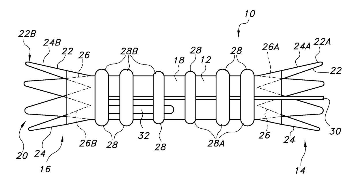 Advanced kink-resistant stent graft