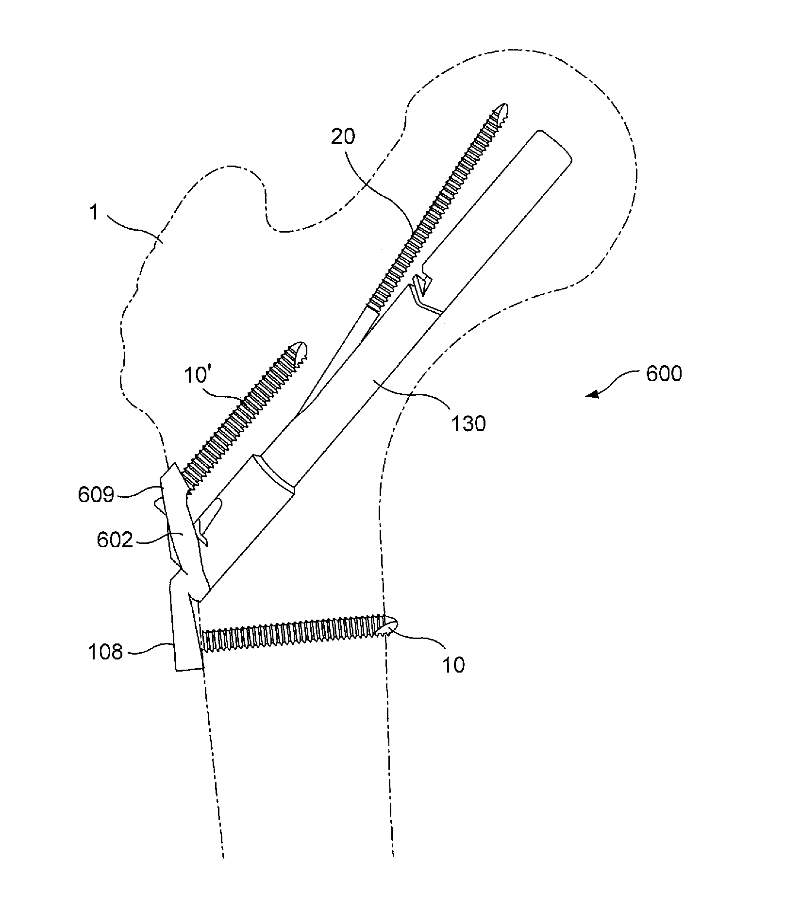 Femoral neck fracture implant