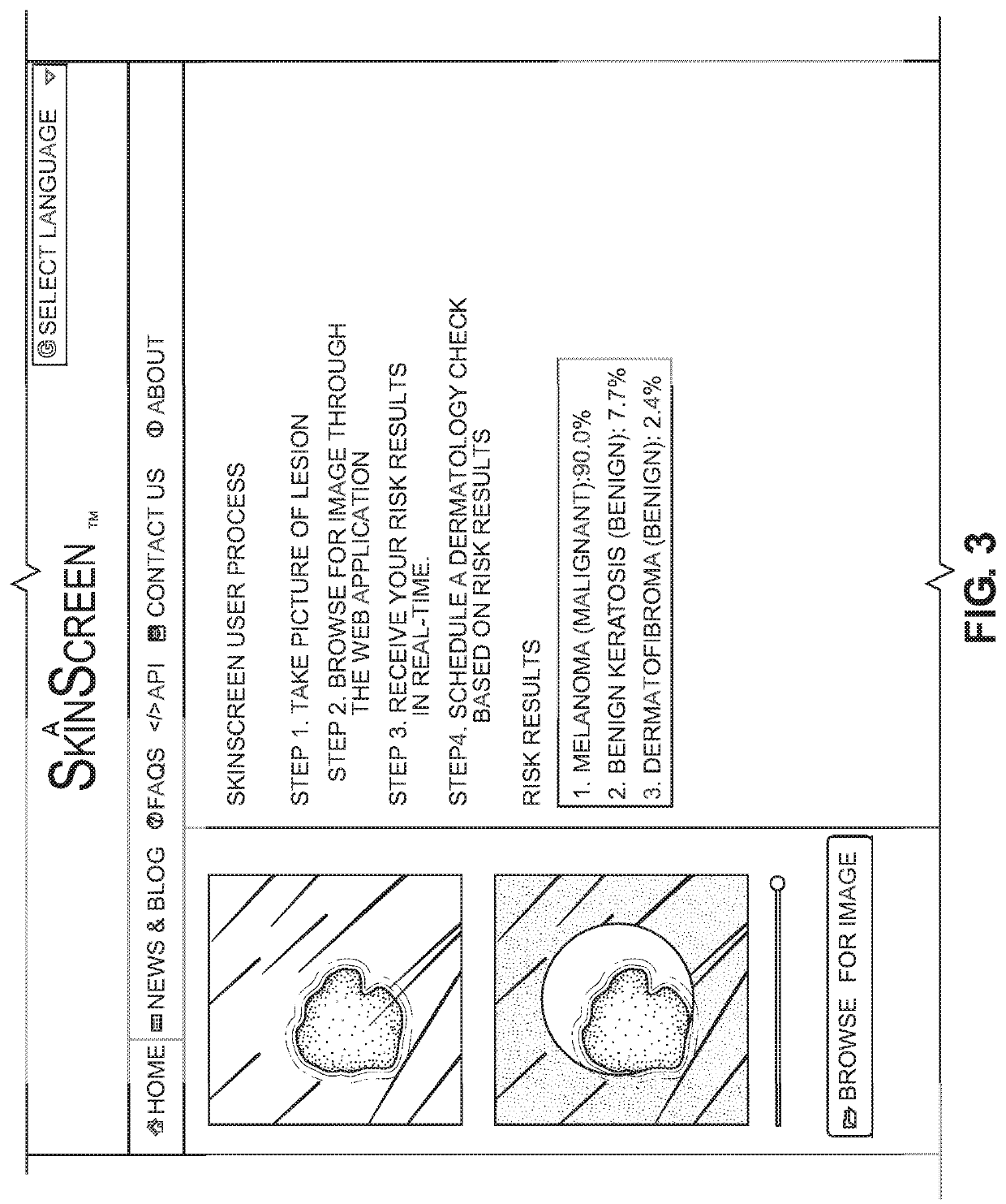 System, method, apparatus and computer program product for the detection and classification of different types of skin lesions