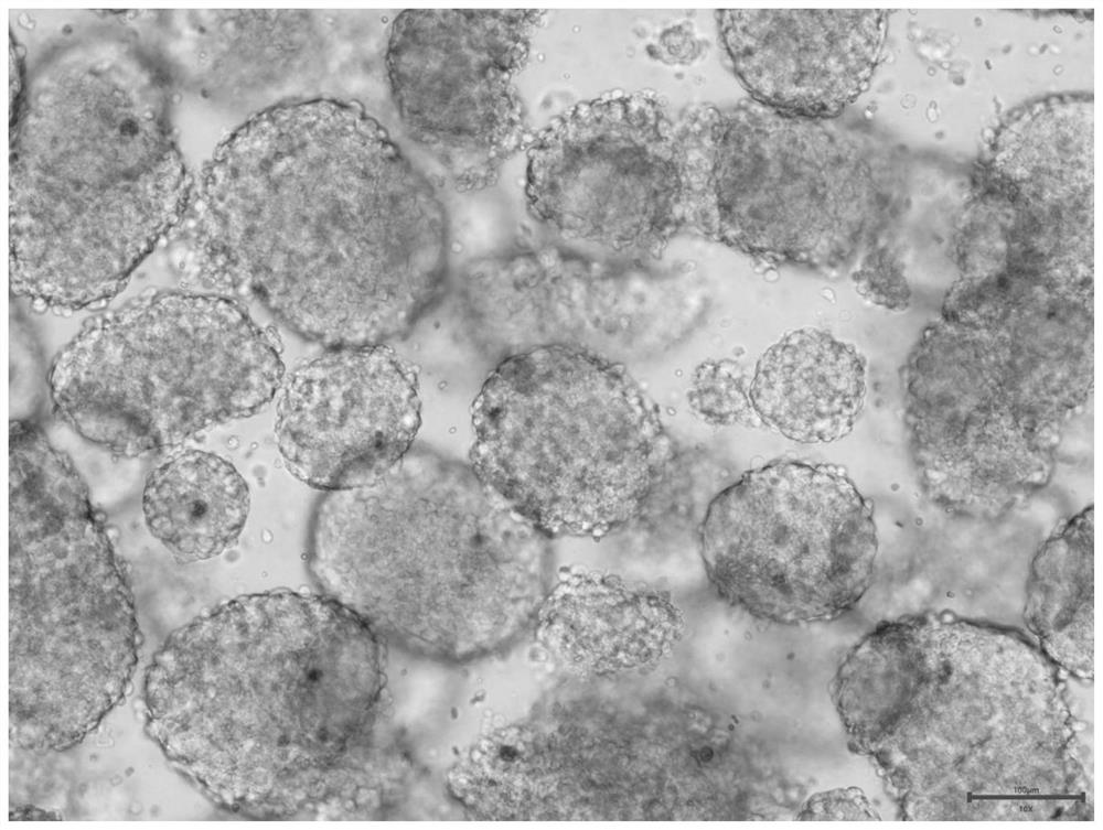 Culture medium for culturing primary cells of solid tumors of bone and soft tissue tumors