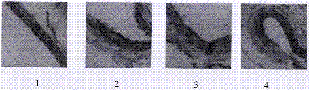 Medicinal composition for treating atherosclerosis and application