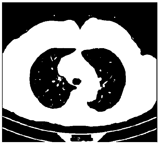 Lung image segmentation method and device and lung lesion area identification equipment