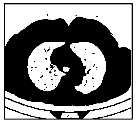 Lung image segmentation method and device and lung lesion area identification equipment