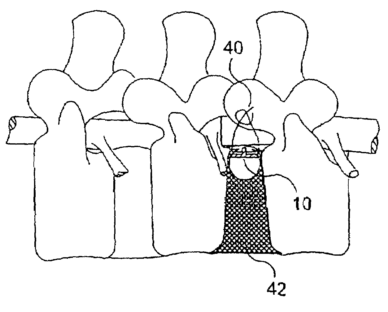 Spinal disc annulus reconstruction method and deformable spinal disc annulus stent