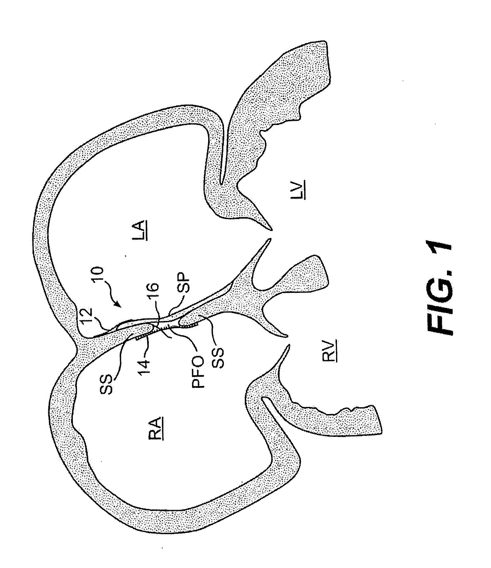 Closure devices, related delivery methods and tools, and related methods of use