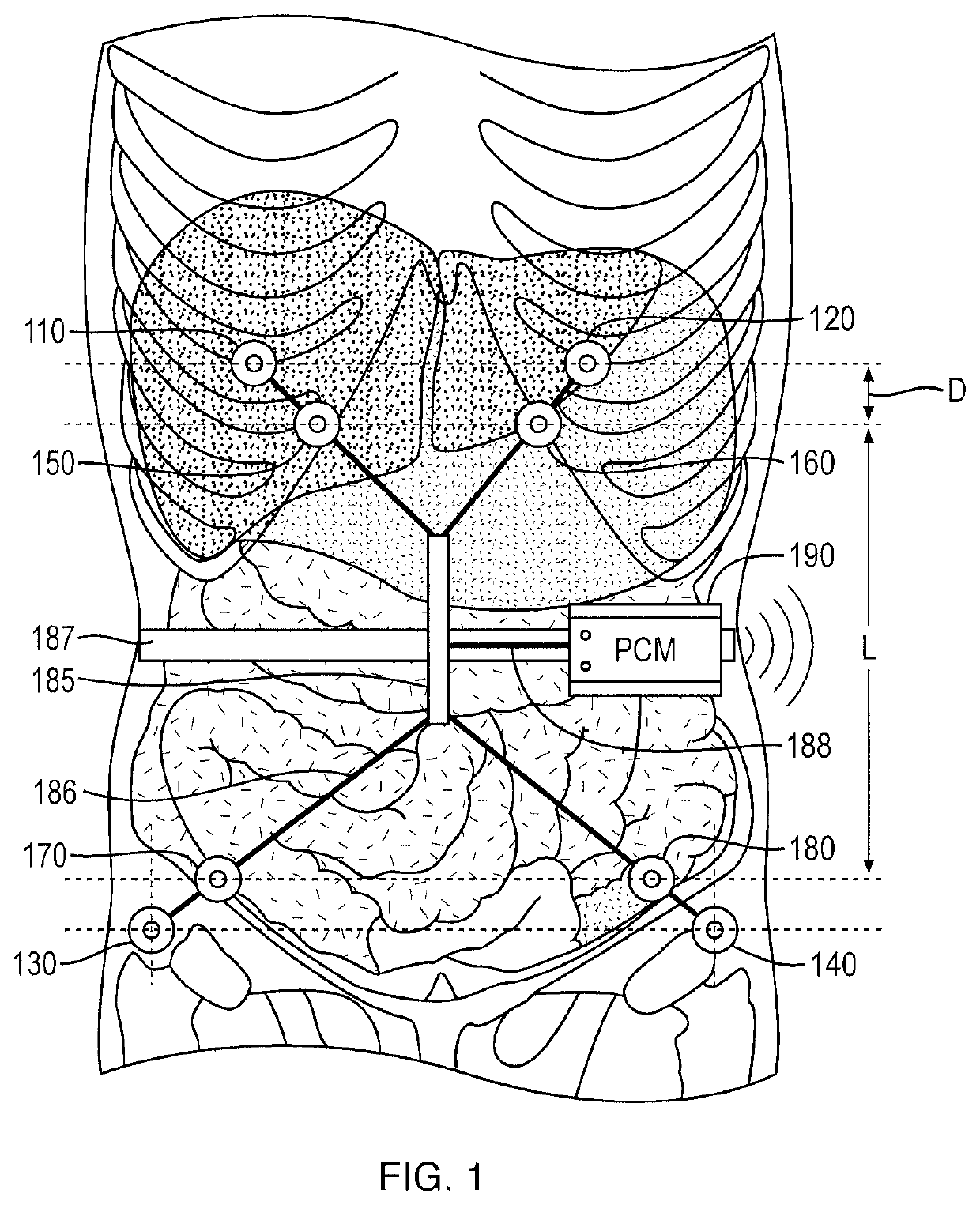 System and method of monitoring and control of ultrafiltration volume during peritoneal dialysis using segmental bioimpedance