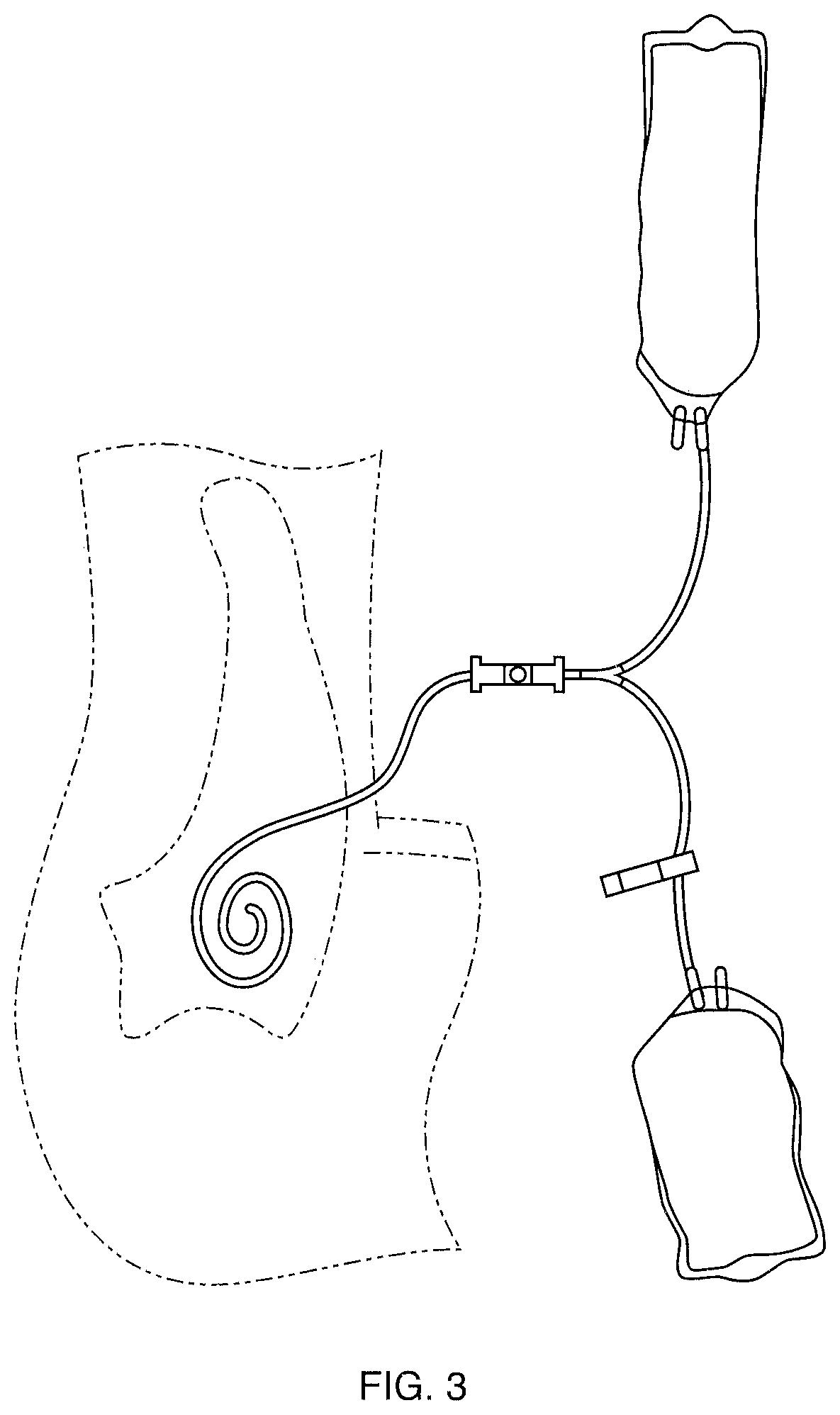 System and method of monitoring and control of ultrafiltration volume during peritoneal dialysis using segmental bioimpedance