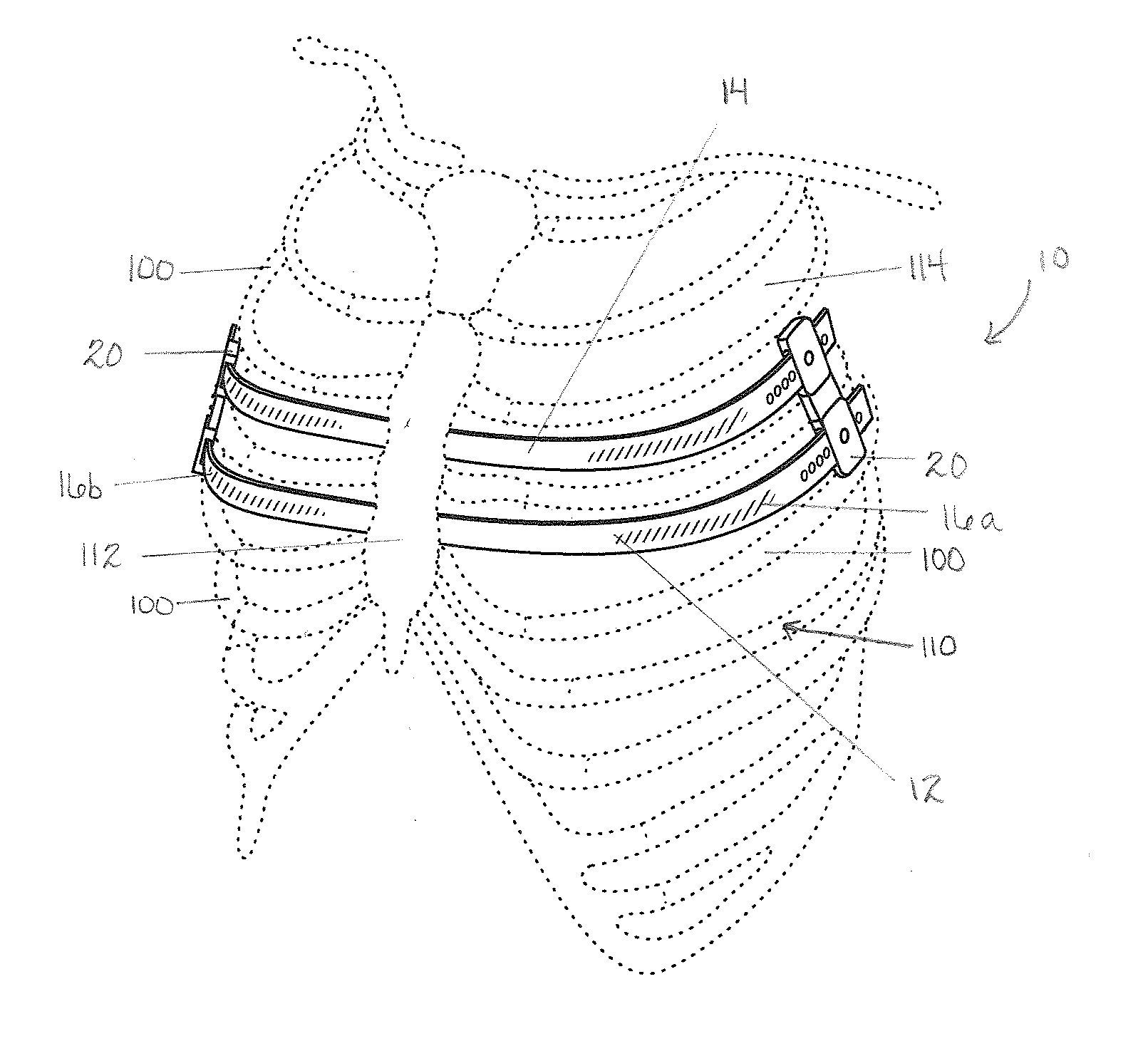 Apparatus and method for treating pectus excavatum