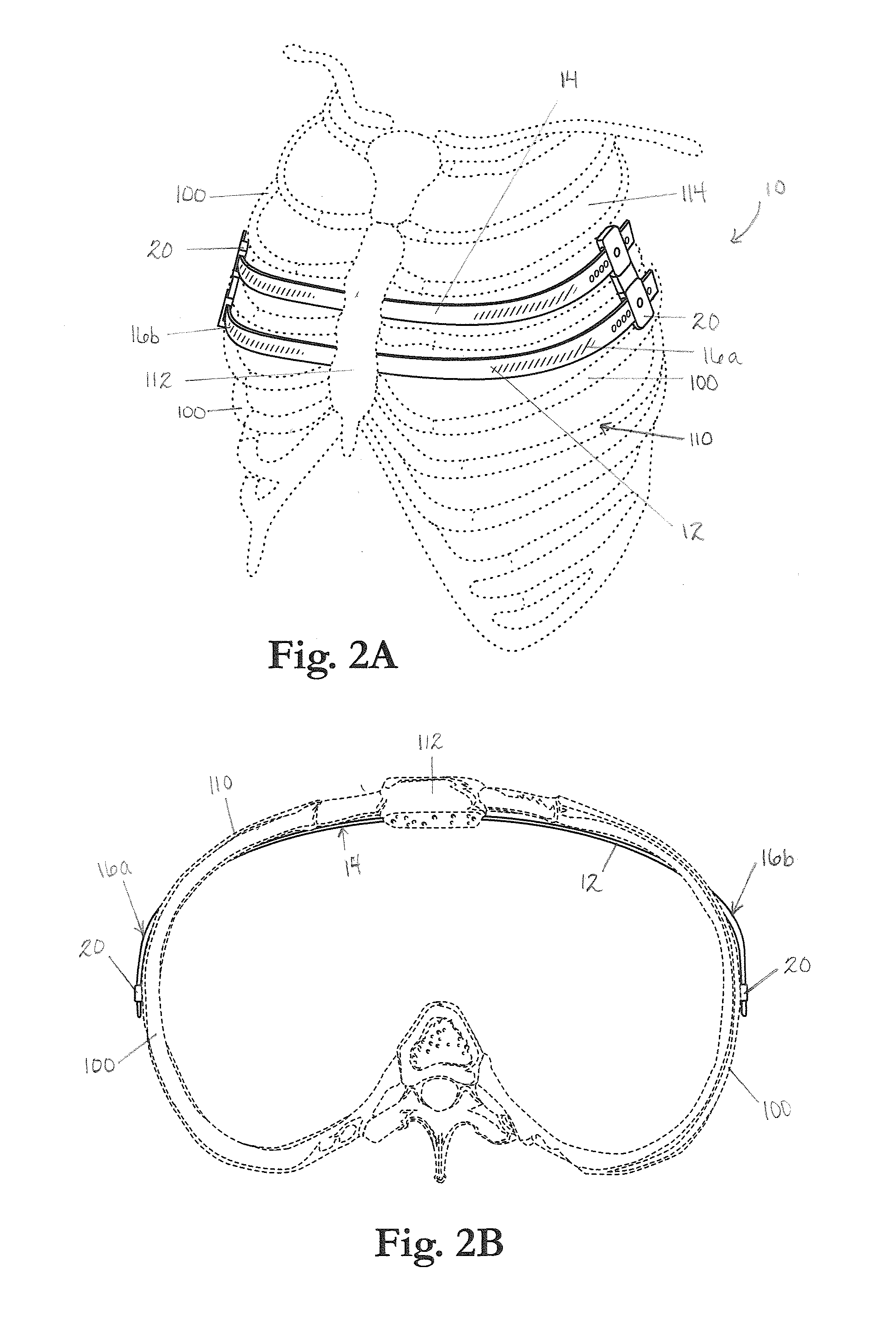 Apparatus and method for treating pectus excavatum