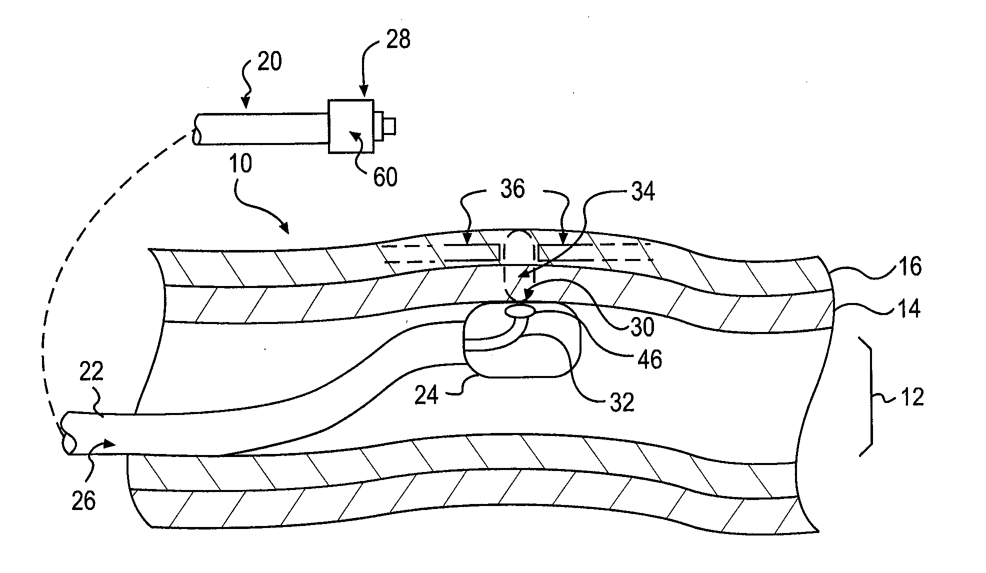 Catheter device and method for denervation