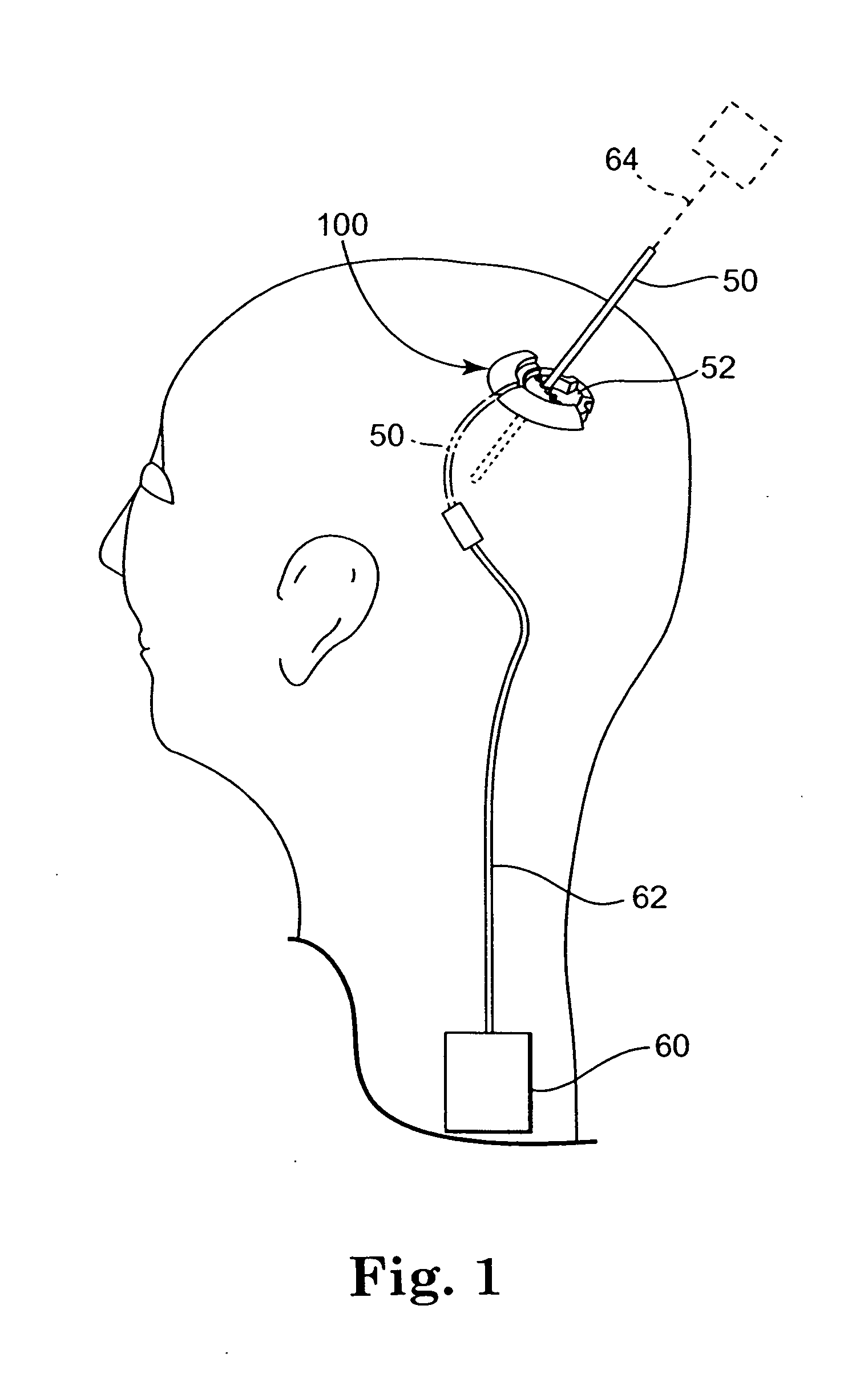 Methods and apparatus for securing a therapy delivery device within a burr hole