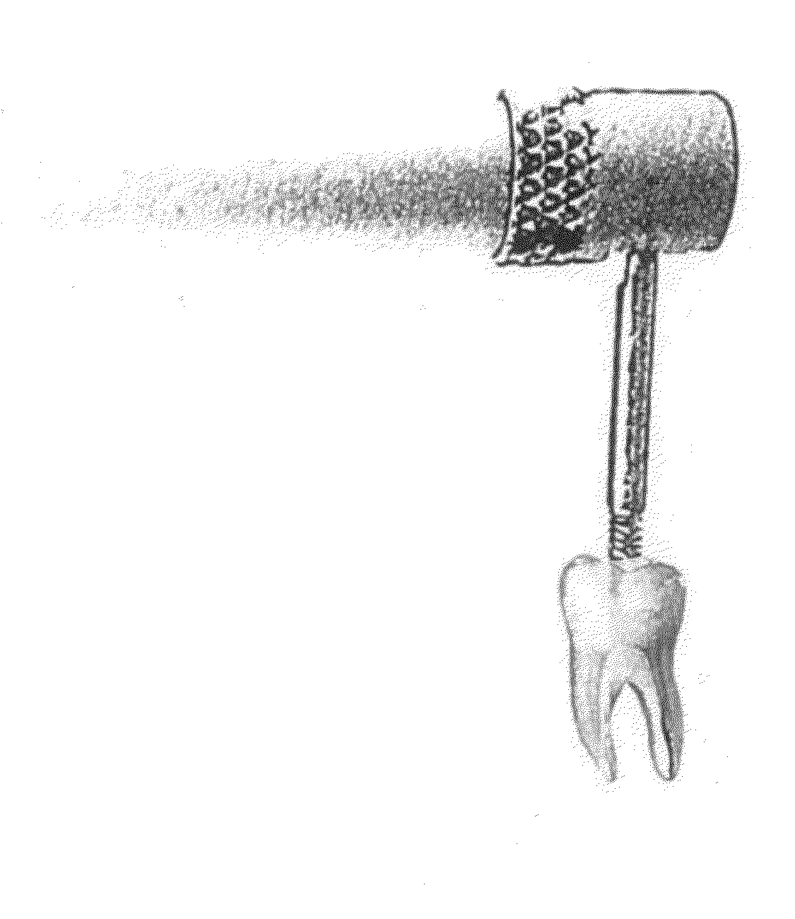 Dental Extraction Burs for Extraction of a tooth or a portion of a Tooth