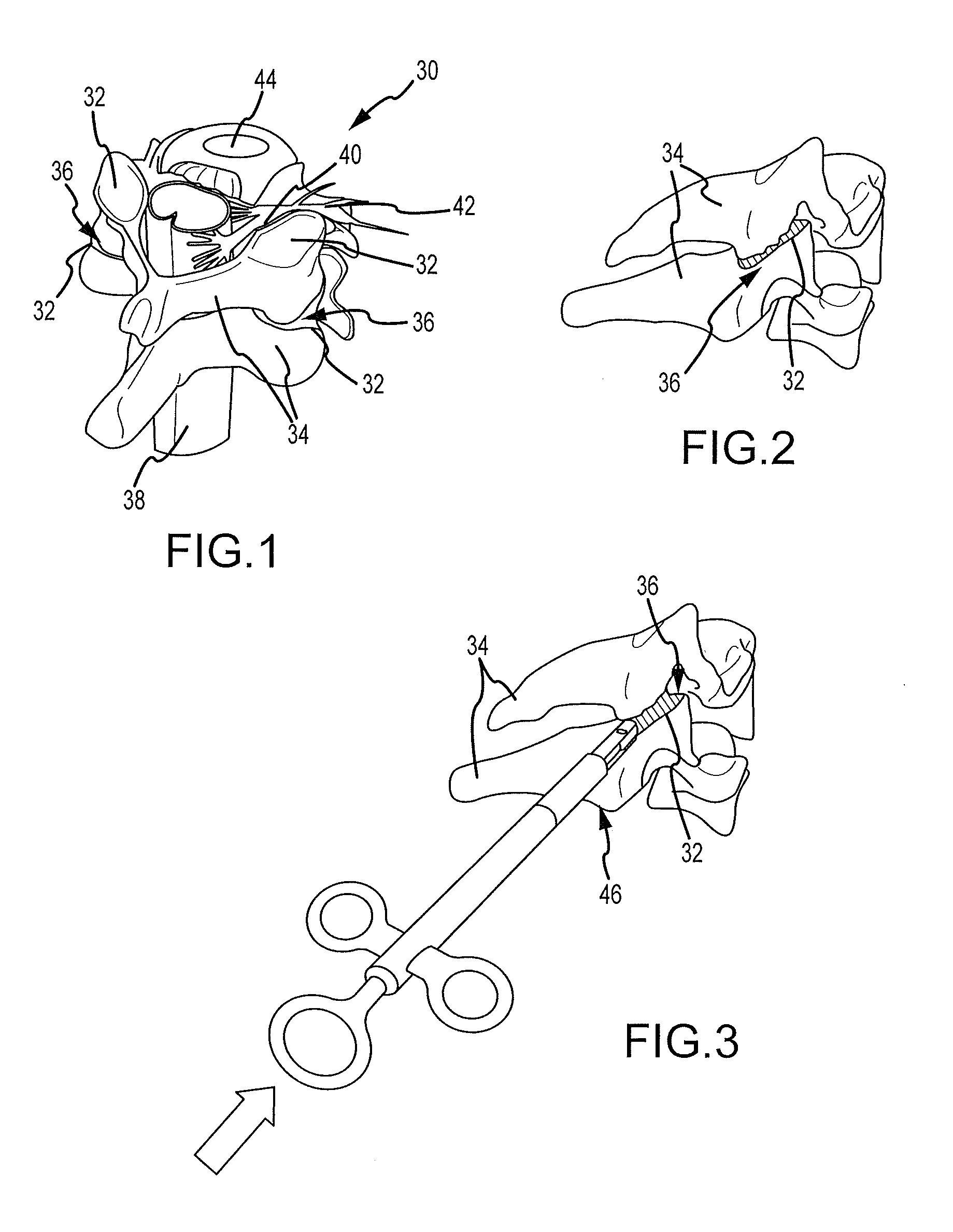 Cervical distraction/implant delivery device